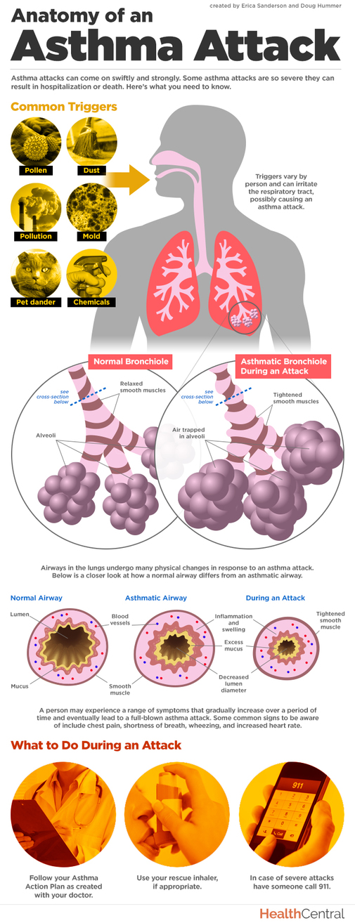 A picture of the anatomy of an asthma attack.